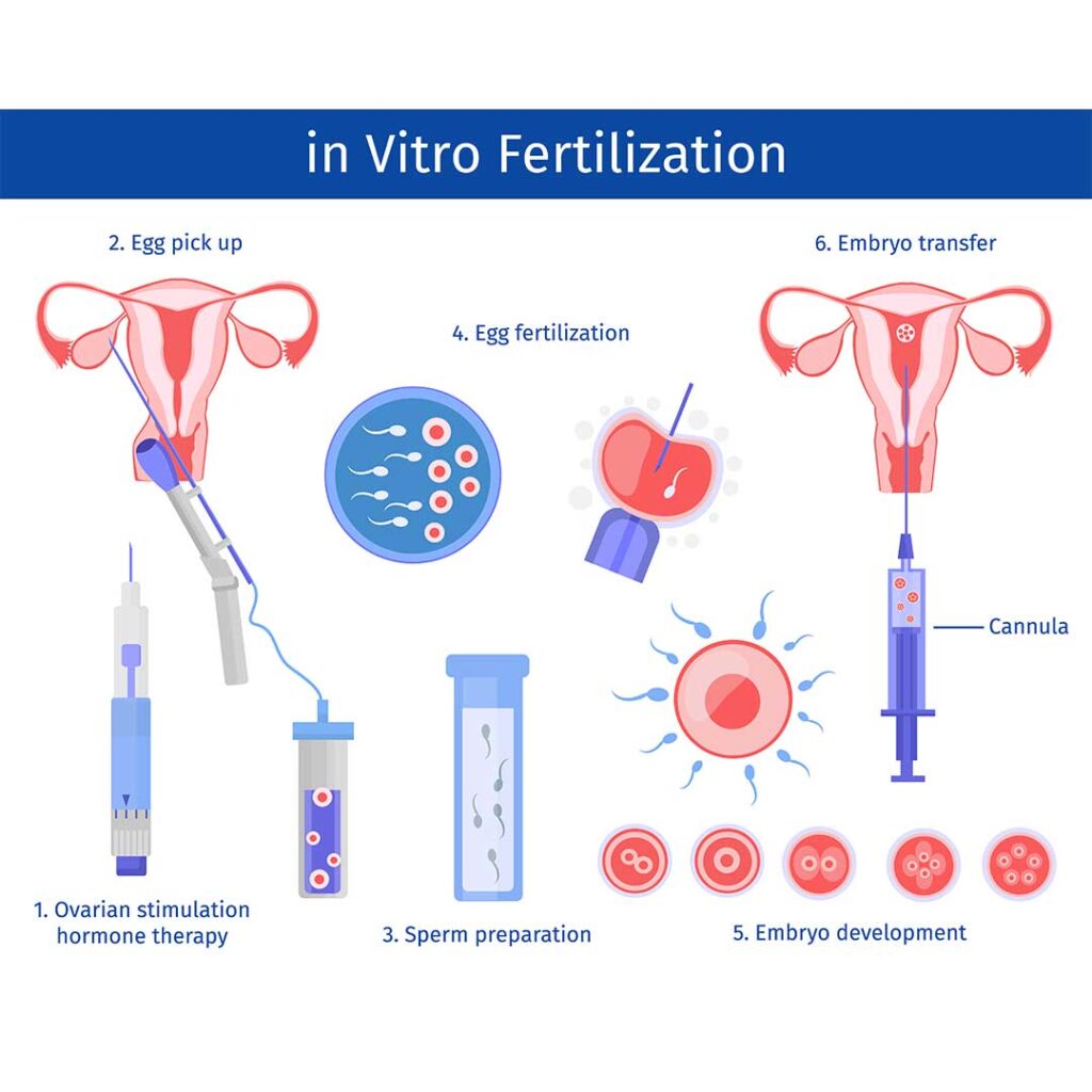 In Vitro Fertilization Ivf Craft
