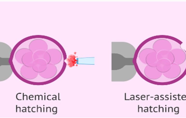 Assisted Hatching in IVF: Procedure, Indications, and Benefits